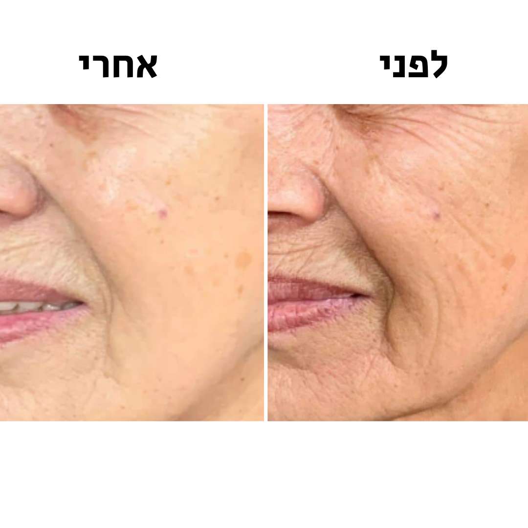 GlowMe-SkinWavePro™-מכשיר מתיחת פנים