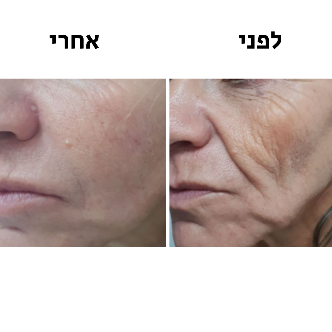 GlowMe-SkinWavePro™-מכשיר מתיחת פנים